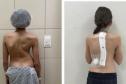 Paraná é referência em cirurgias de deformidade da coluna vertebral