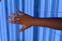 Hospital Dermatológico do Paraná é referência no tratamento integral e gratuito de vitiligo