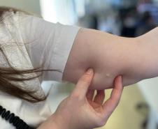 Implante contraceptivo de até R$ 4 mil chega gratuitamente ao SUS no Paraná