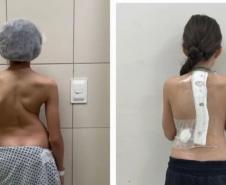 Paraná é referência em cirurgias de deformidade da coluna vertebral