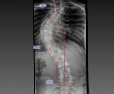 Paraná é referência em cirurgias de deformidade da coluna vertebral