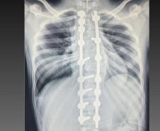 Paraná é referência em cirurgias de deformidade da coluna vertebral