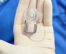 Paraná assume liderança nacional em implantes de correção auditiva pelo SUS