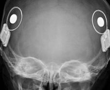 Paraná assume liderança nacional em implantes de correção auditiva pelo SUS