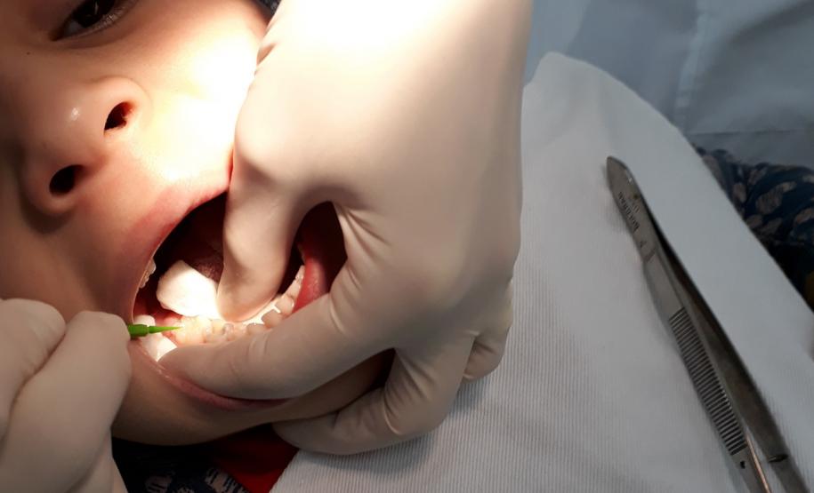 5,6 milhões de consultas: Governo investiu R$ 72 milhões em saúde bucal desde 2019