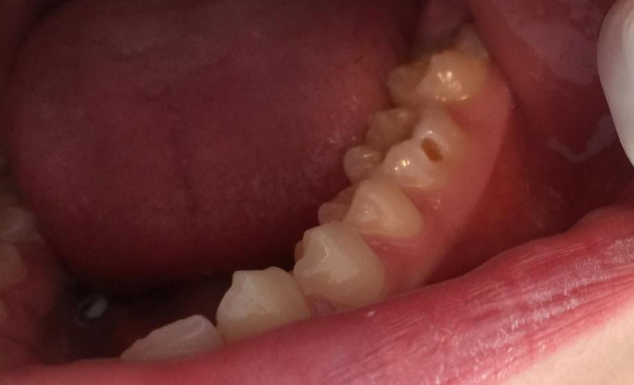 5,6 milhões de consultas: Governo investiu R$ 72 milhões em saúde bucal desde 2019