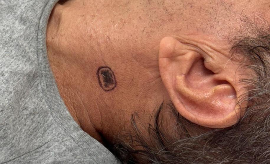 Hospitais concluem mutirão para diagnóstico de câncer de pele na população do Litoral