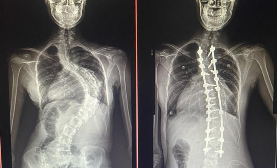 Escoliose - CHT