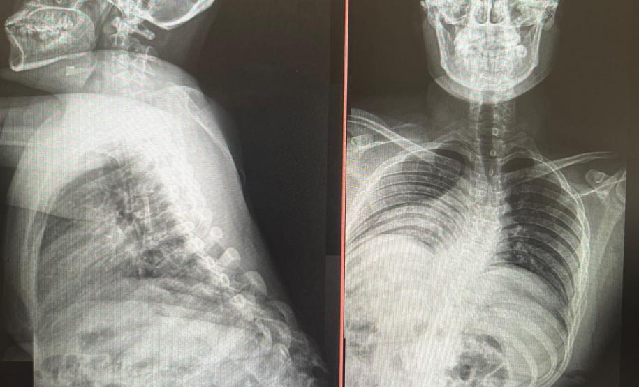 Escoliose - CHT