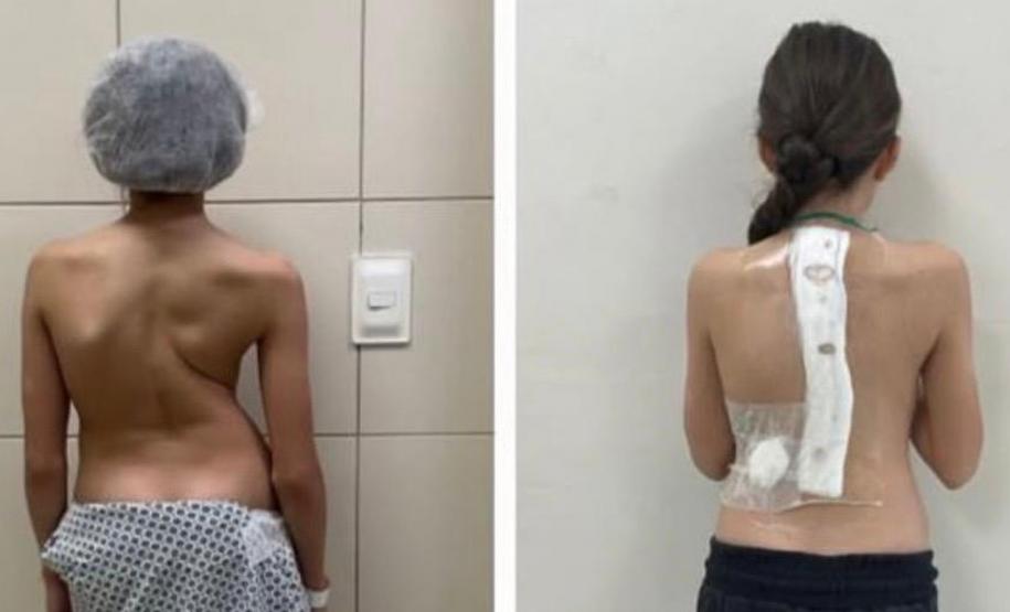 Paraná é referência em cirurgias de deformidade da coluna vertebral