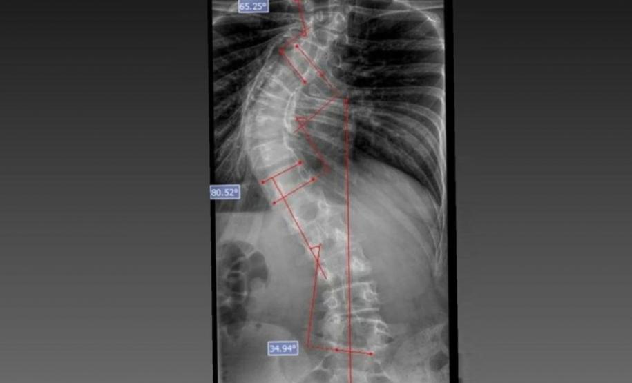 Paraná é referência em cirurgias de deformidade da coluna vertebral