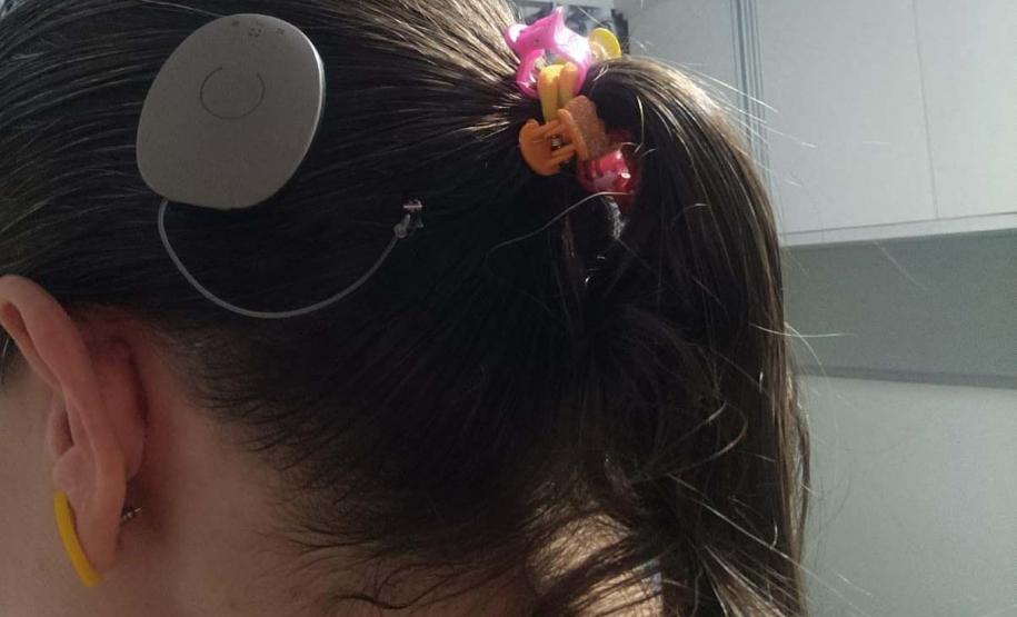 Paraná assume liderança nacional em implantes de correção auditiva pelo SUS