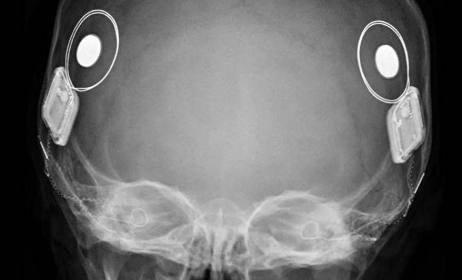 Paraná assume liderança nacional em implantes de correção auditiva pelo SUS