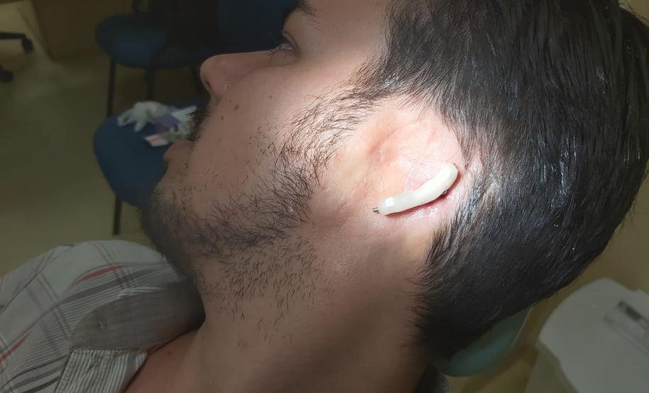 Ambulatório de Próteses Faciais Reconstrutivas inicia atendimentos pelo Sus