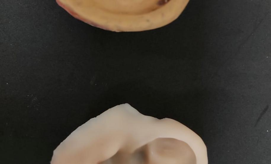 Ambulatório de Próteses Faciais Reconstrutivas inicia atendimentos pelo Sus