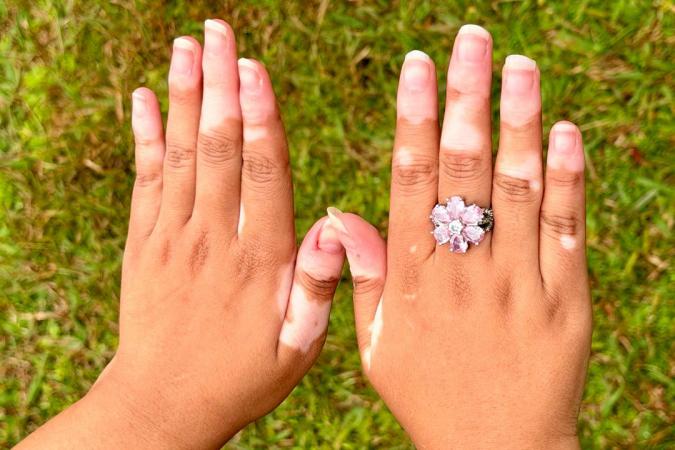 Vitiligo no Paraná: SUS amplia tratamento integral no Hospital Dermatológico